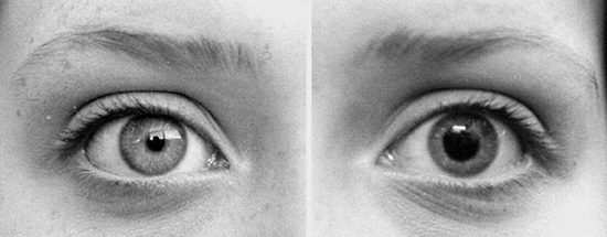 Dilated-Vs-Contracted-Pupils